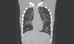 Doğum kontrol implantı akciğerinde bulundu