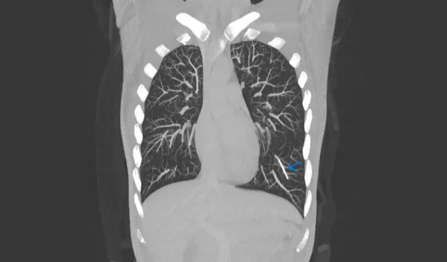 Doğum kontrol implantı akciğerinde bulundu